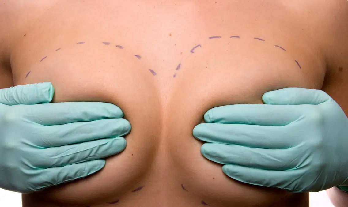 Augmentation mammaire : choisir la bonne technique