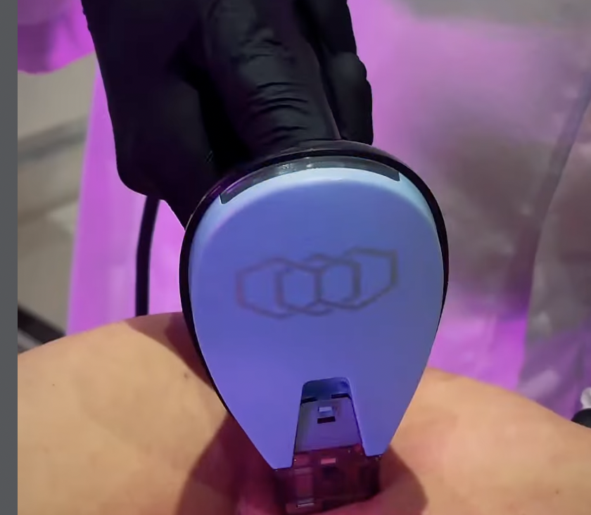Morpheus8 Body – Burst Deep : Optimiser les Résultats Après une Liposuccion des Bras